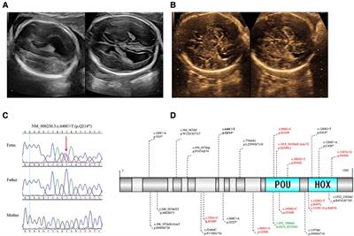 A de novo heterozygous POU3F3 genotype for the p.(Q214*) variant in a fetus with transient isolated bilateral mild ventriculomegaly: a case report and review of the literature